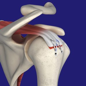Rotator Cuff Repair