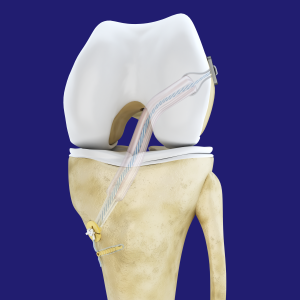 Cruciate Repair & Reconstruction