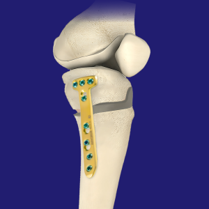 High Tibial Osteotomy (HTO)
