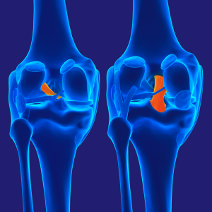 Cruciate Repair & Reconstruction