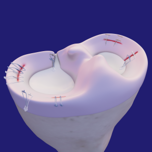 Meniscus Repair