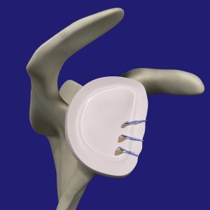 Shoulder Instability Repair
