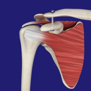 AC Joint Separation Repair
