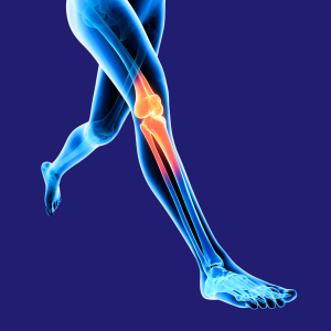 High Tibial Osteotomy (HTO)