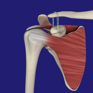 Shoulder Fracture and Dislocation Repair